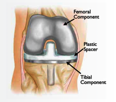 Replacing Worn Joints