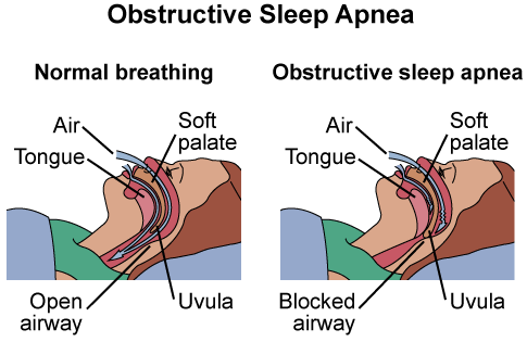 Sleep Apnea Diagram